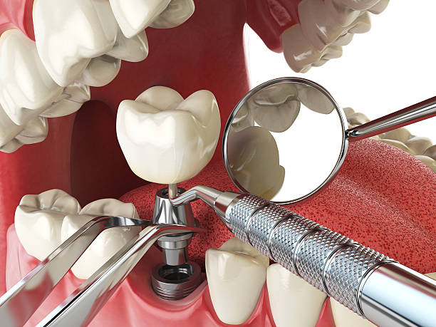 Best Emergency Wisdom Tooth Extraction in Afton, WY